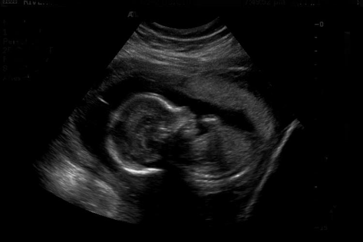 Ultrasound of a fetus