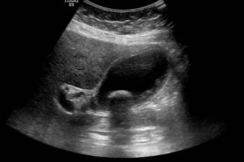 Ultrasound of the Gall bladder
